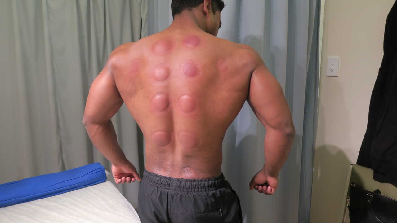 What is Chinese cupping massage